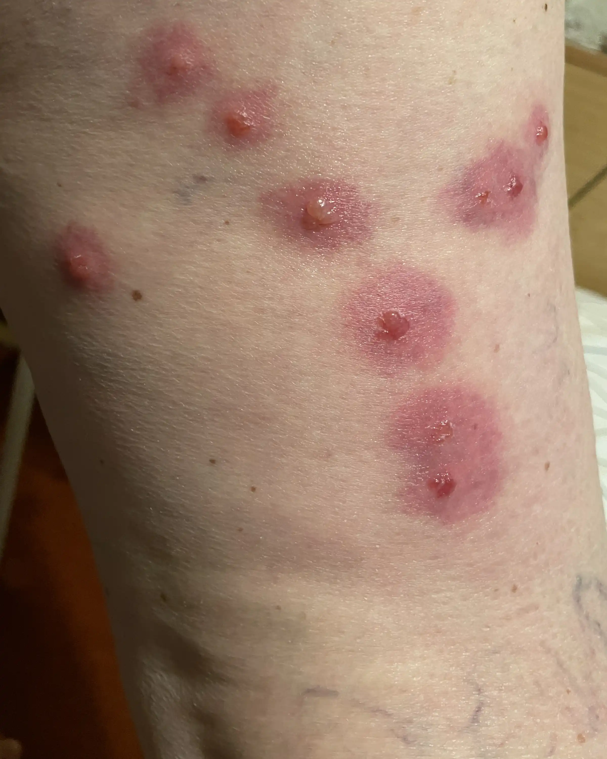 Can You Get Herpes From Bed Bugs At Abel Roque Blog Can You Get Herpes From Bed Bugs At Abel Roque Blog