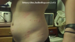 Brittany shows her side covered in bed bug bites.