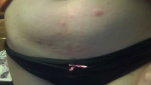 Brittany was bitten on her lower belly by bed bugs.
