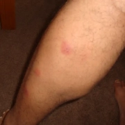 Bedbug bites on calf muscle.