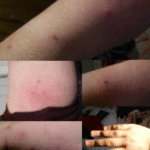 Thirty bed bug bites on Emily