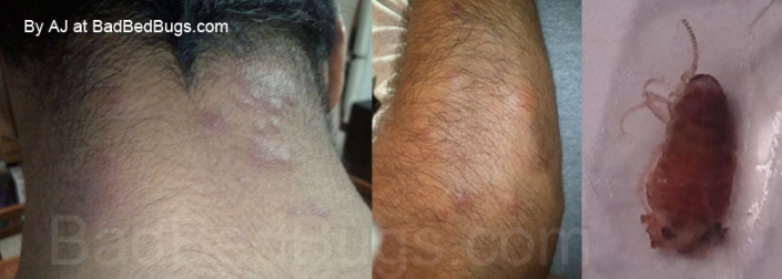 bedbug bites dark skin raised swollen welts