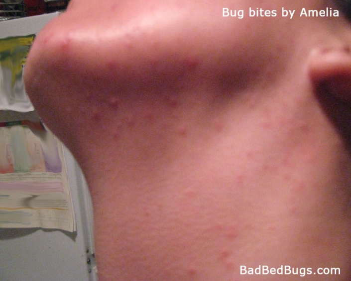 bedbug bites on womans neck and face