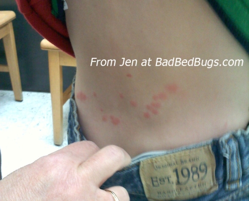 Jen shows her sons back bitten by bed bugs