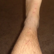 Bedbug bites on Richard's left leg.