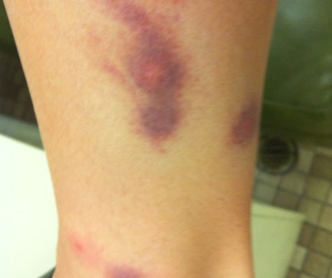 Leg is scarred from bed bug bites