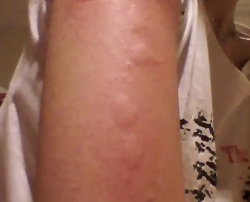 Raised bed bug bites on arm.