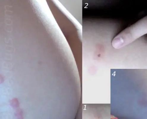 Bedbug bites on a line on the arm on cheek.