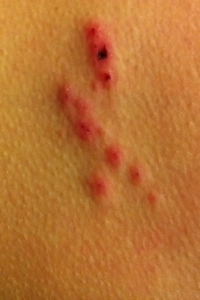 Debbie found a bed bug on her and it made this bites.