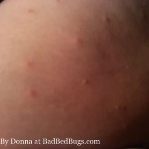 These red swollen bumps are from bed bugs.