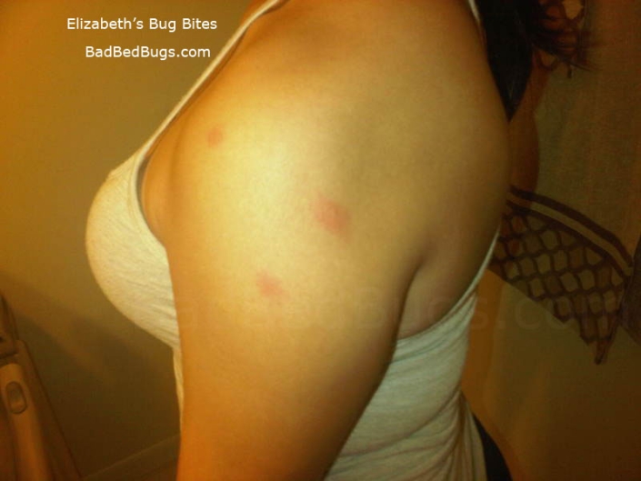 A bed bug bit shoulder multiple times