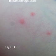 ET's bedbug bites