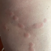 Example of a line forming a pattern of bed bug bites.