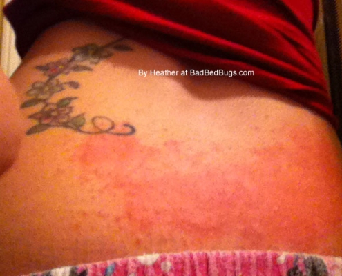 Bed bug rash on back of Heather