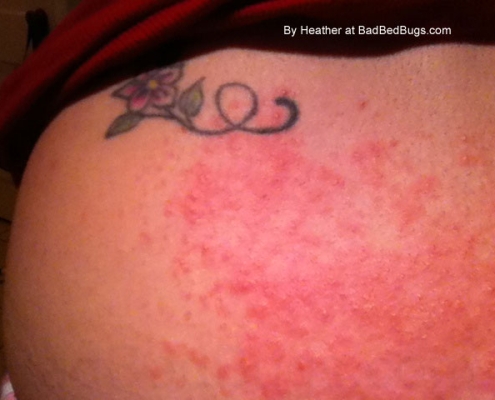 Bed bug rash stage 2