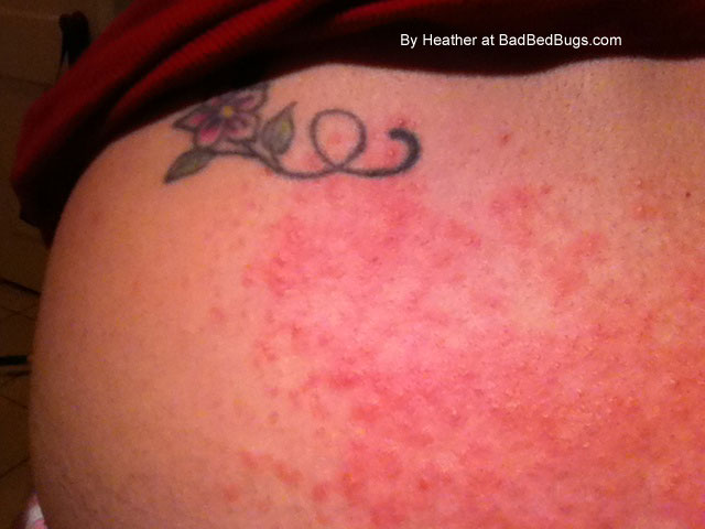 Heather's Bedbug Bites