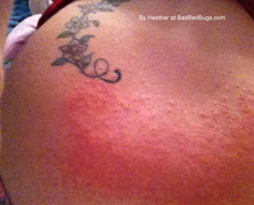 Bed bug rash stage 3