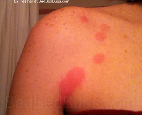 Bed bug bites on shoulder of Heather