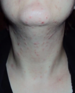 Bites from an itch mite on womans neck.