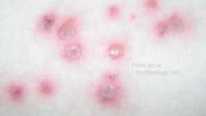 A close up of red bed bug bites healing after scratching.
