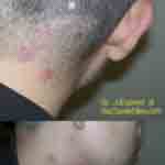 Images of bedbug bites on neck and face of Joe