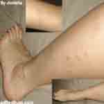 Jonishas Bedbug Bites on her legs