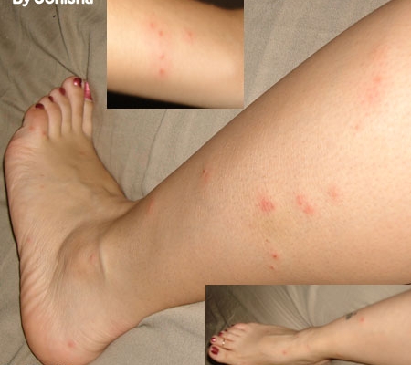 Jonishas Bedbug Bites on her legs