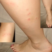 Bed bug bite pattern shown on Jonisha's legs.