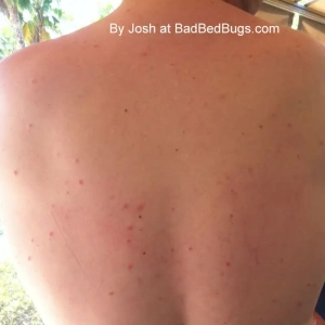 Another picture of Josh's bed bug bites covering his back.