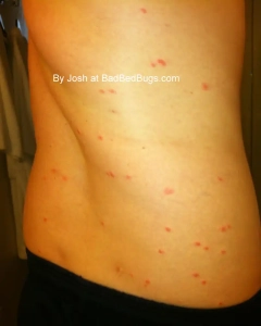 Bedbug bites cover Josh's backside.