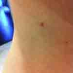 Karnes bed bug bite