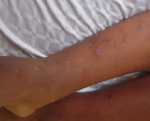 Karina was bitten by bed bugs on her leg.
