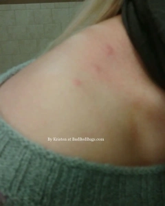 Kristen's bed bug bites on her shoulder.