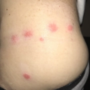 Line of bed bug bites on lower back.