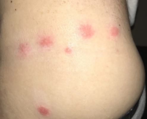 Line of bed bug bites on lower back.