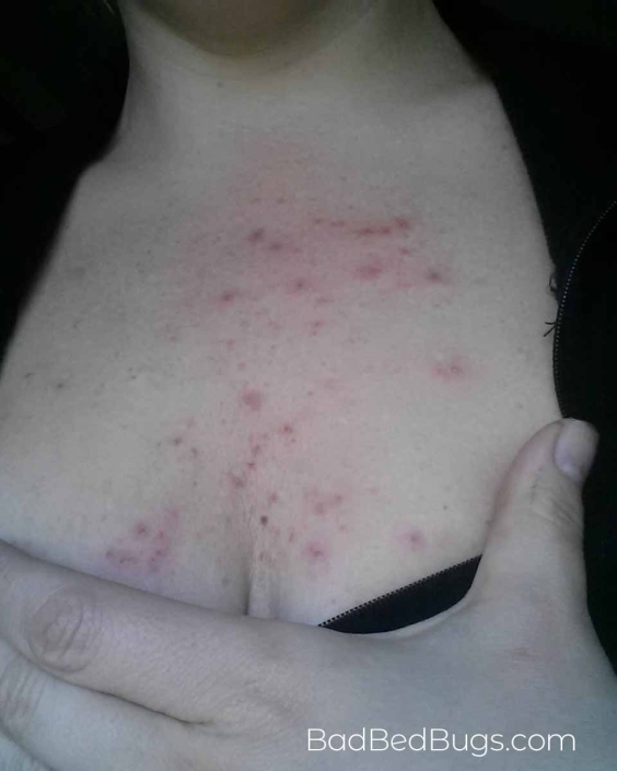 Bed bug bites on Niki's chest
