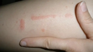 The line of bites may indicate you have bed bugs.