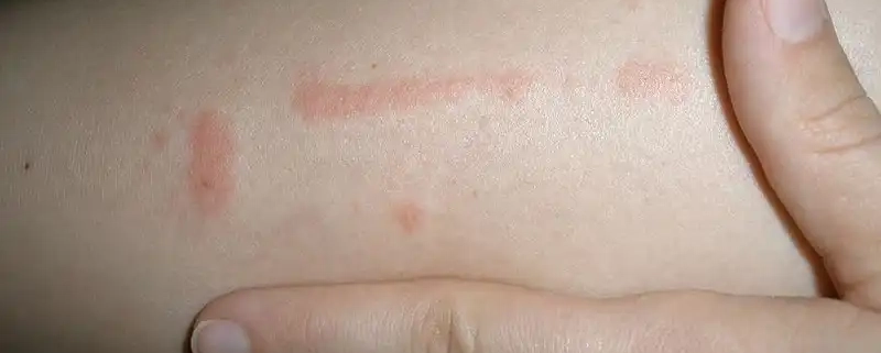 The line of bites may indicate you have bed bugs.