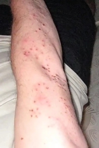 Mans arm showing multiple bed bug bites.