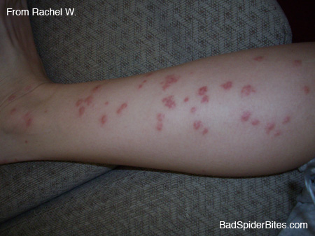 Dark red swollen bedbug bites on leg