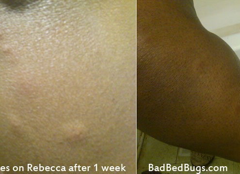 Bed bug bite on black womans leg
