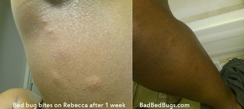 bed bug bite hotel bedbugs bites bugs hotels week