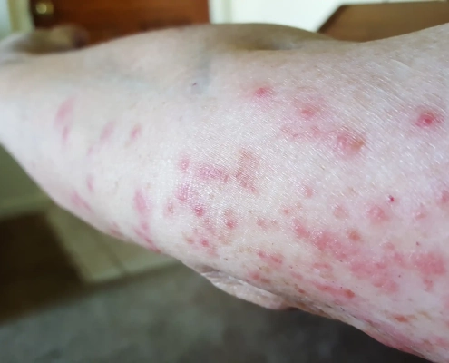 This red rash is from bed bugs biting the arm.