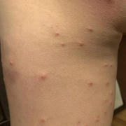 Red bumps covering leg are from bed bug bites.