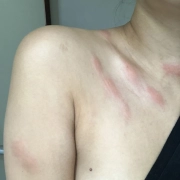 Red swollen bed bug bites on woman's chest and arm.