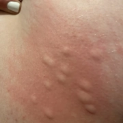 Swollen red itchy bites shown in a cluster may indicate you were bitten by bed bugs.