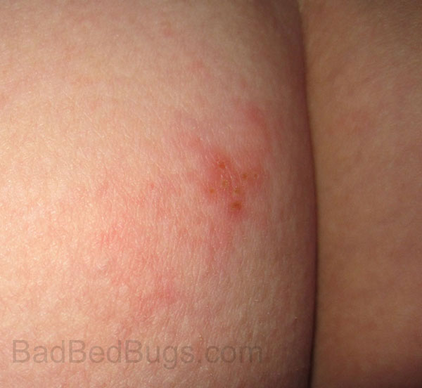 Bed Bug Bites on Sally Mae's butt