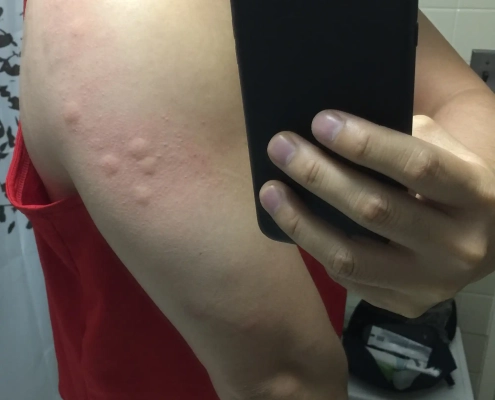 Swollen red bed bug bites on upper arm in cluster.