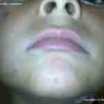 Childs face bitten by bed bugs