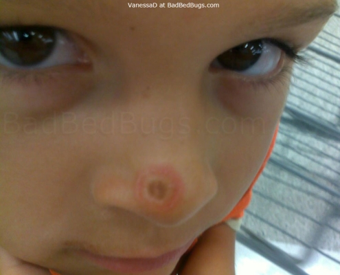 Bed bug bite on child's nose